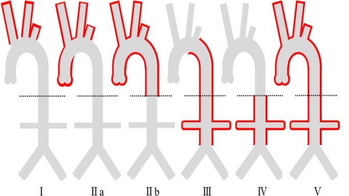 Figure 6: Showing types of Takayasu arteritis depending upon the extent and distribution of pathology.
