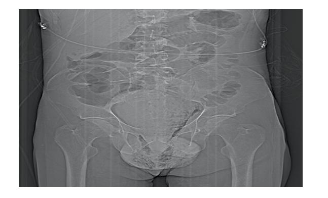 Figure 1: Scout view of abdominal CT showing scrotal tumefaction with gas bubbles in scrotal and pelvic projection.