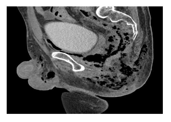 Figure 2: Sagittal views of pelvic CT with contrast at excretory phase confirms gas bubbles dissecting inside and outsider the pelvis.