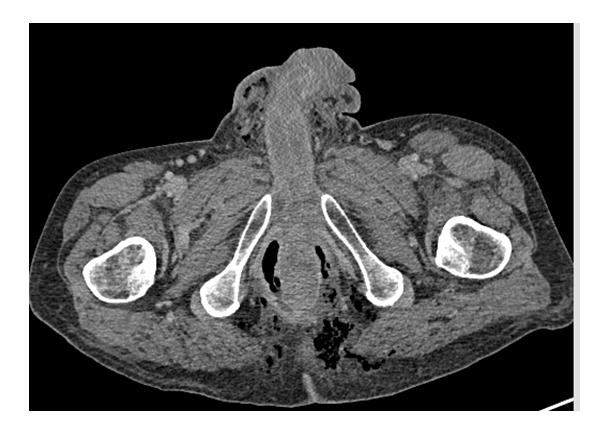 Figure 3: Axial CT with contrast at the level of the distal third of the rectum showing horseshoe perianal abscess and gas bubbles.