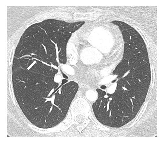 Figure 3: Control CT performed 12 months later showing thin residual linear scar of pulmonary infarction (white arrow).