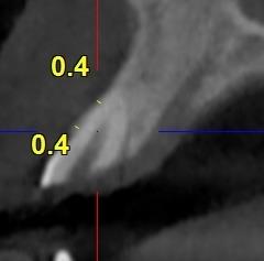 Figure 1: Smokers and individuals with systemic diseases contraindicating placement of dental implants were excluded.