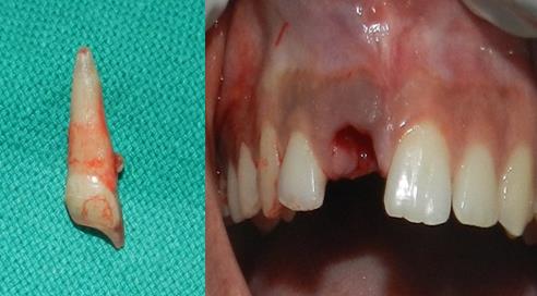 Figure 5: Loss of labial cortical plate during immediate implant placement.