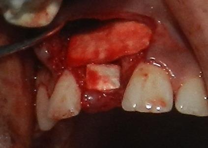Figure 6: Guided bone regeneration with xenograft and barrier membrane.
