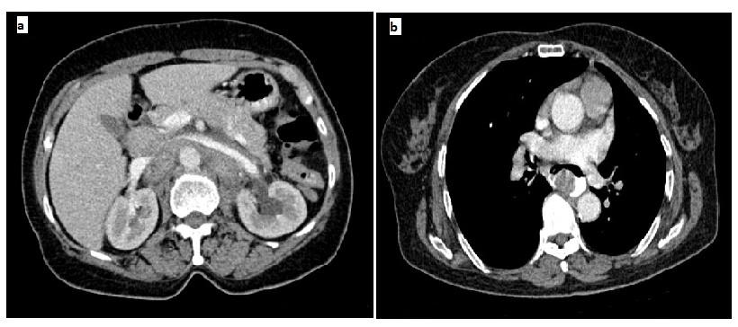 Figure 5: a) Post treatment CT scan images shows reduction in retroperitoneal lymphadenopathy.
