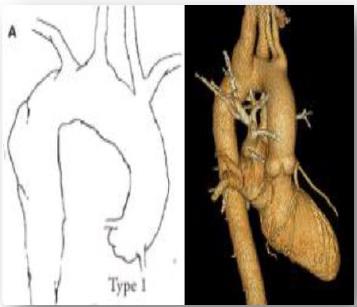 Figure 6: Type 1 right sided aortic arch with mirror image branching.