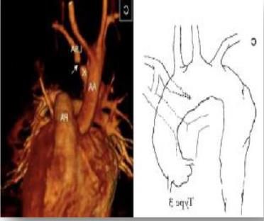 Figure 8: Type 3 Right sided aortic arch with isolated left subclavian artery.