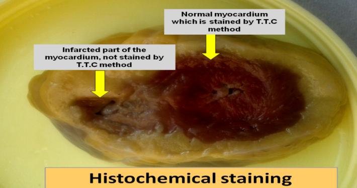 Figure 2: The coronaries were examined for the degree of stenosis, presence of thrombus, calcification or hemorrhage into an atheromatous plaque. This was done by cutting transverse sections of the coronaries and their main branches at 3 mm intervals.