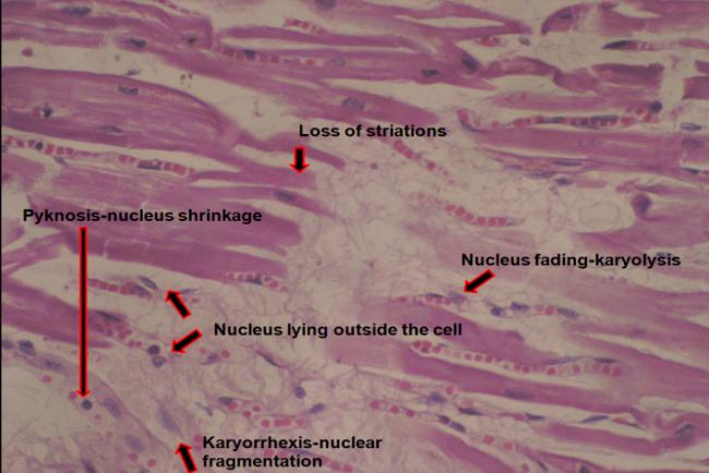 Figure 4: Degree of stenosis was calculated using this diagrammatic representation.