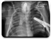 Figure 1: Chest X-ray post insertion of a chest drain for a left pneumothorax.
