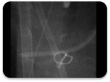 Figure 2: Air Bronchogram showing long segment tracheal stenosis.