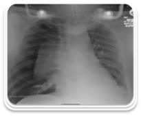 Figure 3: Chest X-ray showing a right pneumothorax. These cases illustrate how task fixation in upper airway management can result in failure to diagnose and manage other synchronous pathologies. We have reflected on these cases in our local practice, to consider learning points and strategies for avoidance of fixation on one particular pathology, and move on to other differentials once the airway is secured. It is important for both the surgeon and wider multidisciplinary team to be aware of non-upper airway causes of hypoxia; their presentation and management. Airway management should be a team- based approach, similar to aviation practice. This allows all members of the team to contribute equally, and consider alternative diagnoses.