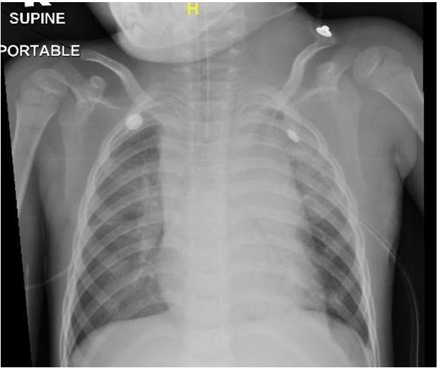 Figure 1: CXR taken on the day of admission. Two days after admission, the patient was referred for an elective intubation to enable the child to proceed with the CT scan and lymph nodes biopsy. After a multidisciplinary discussion, agreed consensus was made that the child should be intubated and ventilated in a controlled environment where difficult airway adjuncts are easily available and varying modes of ventilator settings could be offered.