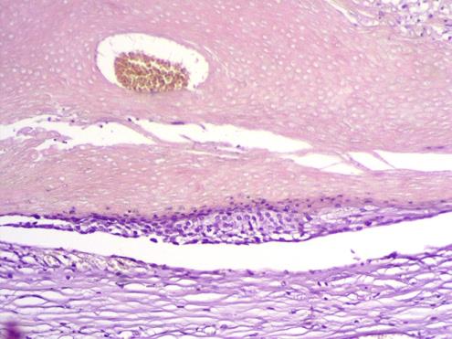 Figure 4: Microphotography showing basaloid cells undergoing brutal keratinization of trichilemmal type thus forming shadow cells (HE, 200X).
