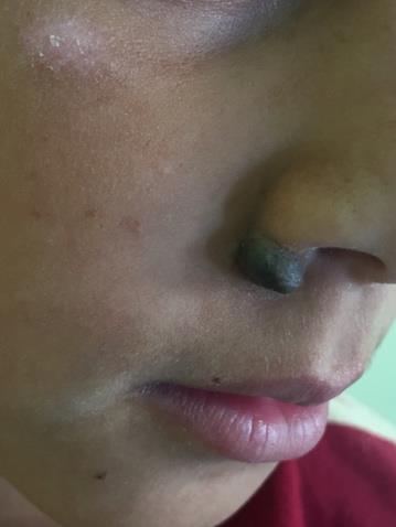 Figure 1: A 10 mm brown bluish nodule of the right nostril.