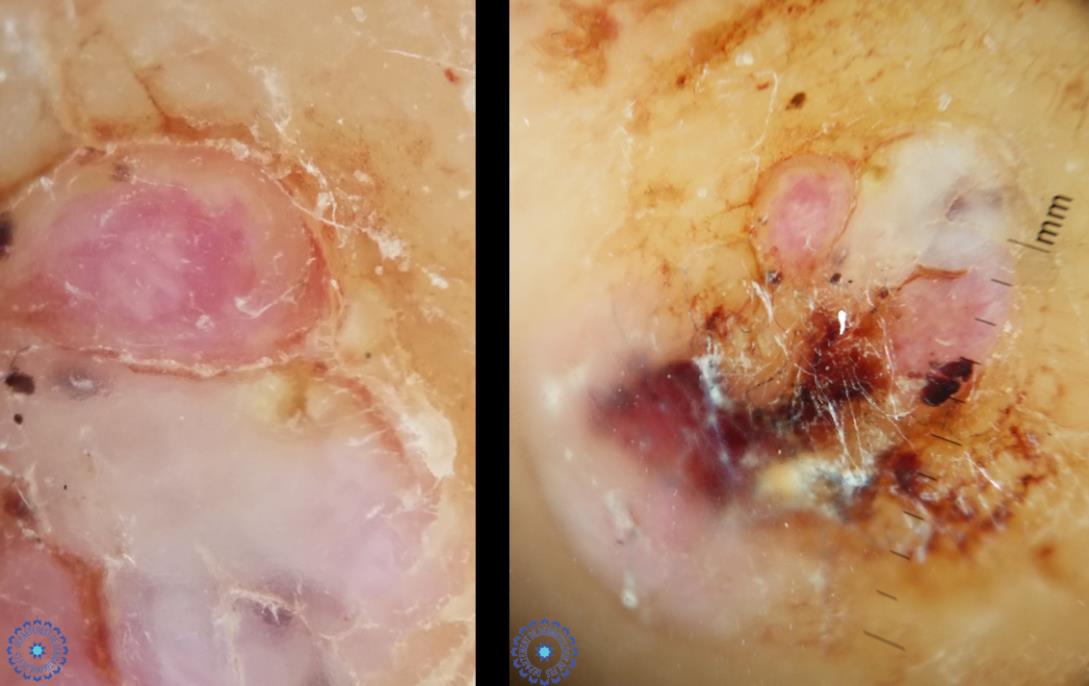 Figure 2: Polarized, contact dermoscopy showinga vascular pattern made of homogeneous lacunas and glomerular vessels by places, the all surrounded by white to pink halos.