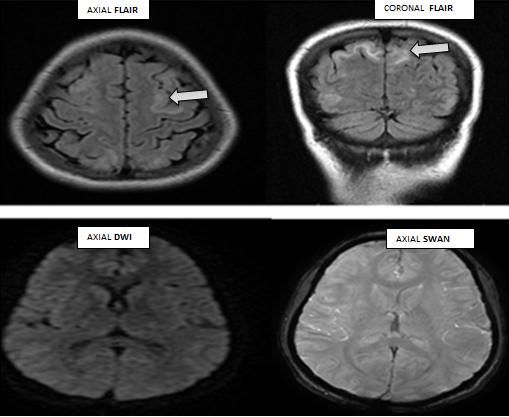 Figure 1: 30 year old female with h/o seizures on post-partum 7th day. Axial/Coronal T2 FLAIR, DWI and SWAN reveals symmetrical FLAIR hyperintense signals involving cortical and subcortical areas in the bilateral parietal region with no restricted diffusion-Suggestive of PRES.