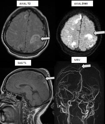 Figure 4: 23 y old women with 5 months of amenorrhea day, c/o headache, Axial T2 FLAIR, DWI, Sag T1 and MRV reveals venous infarct in bilateral frontal lobe secondary to thrombosis of superior sagittal and bilateral transverse sinuses.
