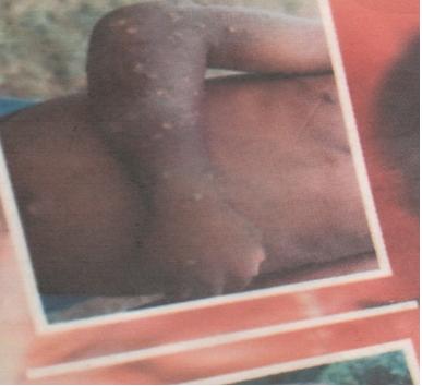 Figure 2: Swelling and rashes of one arm in a 14 year old boy two days after an initiating dose of ivermectin.