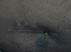 Figure 3: Fistulogram RIF fistula closure after glue.