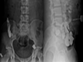 Figure 4: Glue injected through skin opening fistula before glue after glue.