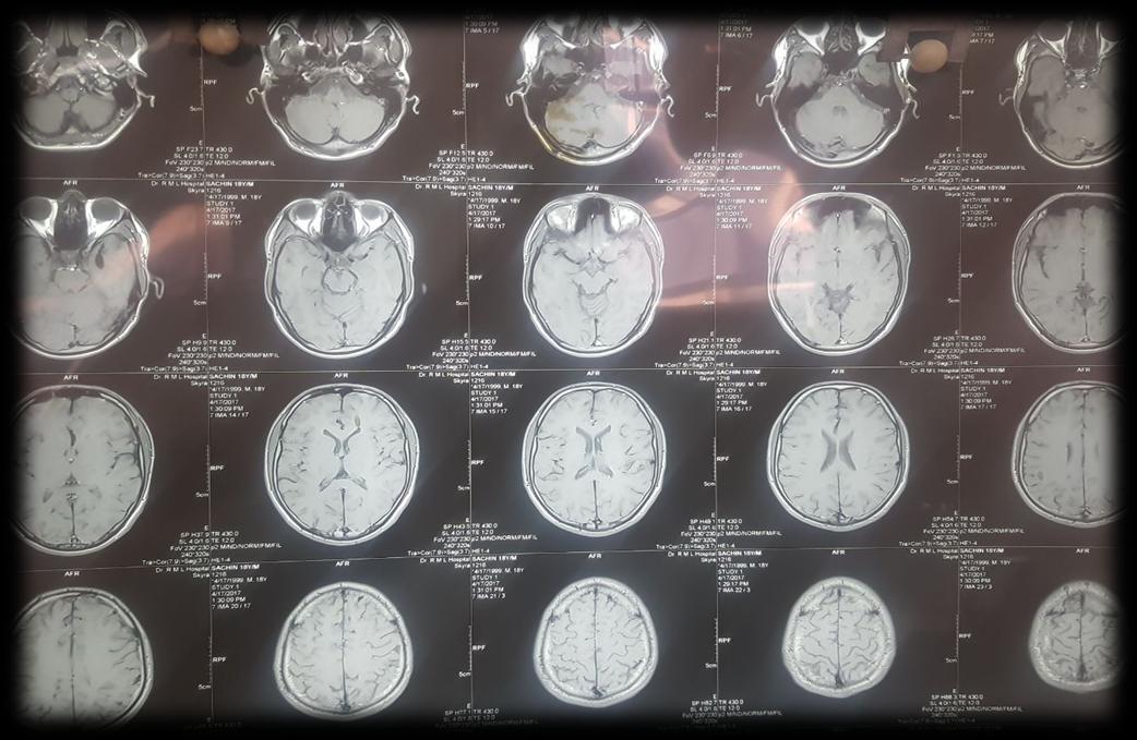 Figure 2: ECHO and MRI brain and orbit were also found unremarkable.