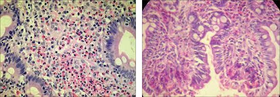 Figure 2: Gastric biopsies showing increased eosinophilic infiltrations in case 3(H& E 40 X).