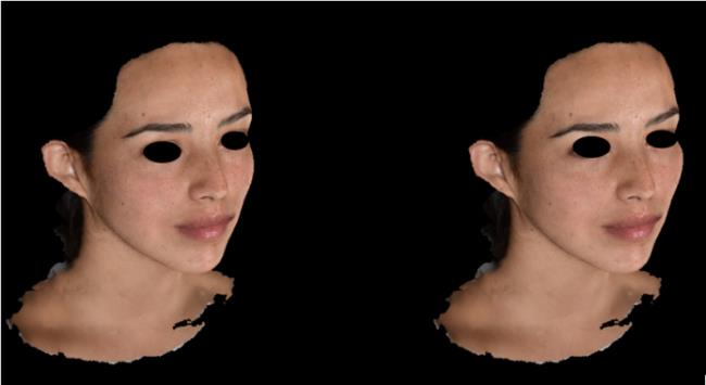 Figure 6: Female 24y, Treatment of Cheekbone, Decoria voluma, 4mL total (2mL per side). Curved cannula technique from NLF.