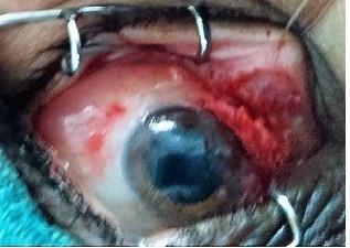 Figure 2: Intraoperative photograph showing dissection of pterygium and subconjunctival mass.