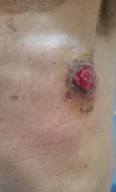 Figure 1: Clinical image showing an erythematous well limited plaque of about 3 centimeters with irregular contours and ulcerated center, bleeding on contact, in the nipple areola complex of the left breast.
