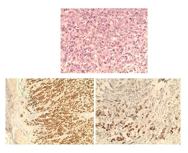 Figure 4: Imminohistochemical images of the biopsy showing a strong and positive nuclear staining for RE, RP and Ki 67 (100 x magnifications).