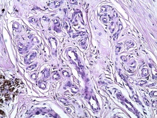 Figure 3: HES staining G x 200 -> Proliferation of capillary vessels with regular endothelium.