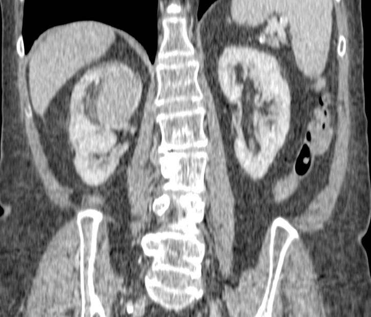 Figure 1: An isolated 4 x 4.2 cm intraparenchymal complex cystic mass of the superior pole of the right kidney is revealed by a multiphasic CT. Density and contrast uptake are compatible with primary renal cell carcinoma.