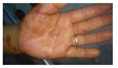 Figure 3: Pustules on the Upper and Lower Limbs.