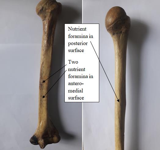 Figure 2: The nutrient foramina were found to be present in all humeri of both sides. The direction of nutrient foramina was not showing any deviation from normal anatomical feature even in single case throughout the study. All the foramina were directed downward or toward the lower end of humeri. The single nutrient foramen was present in 86.66% (26) of right humeri and 80% (24) of left humeri, double nutrient foramina in 13.33% (4) of right humeri and 16.66% (5) of left humeri. Triple nutrient foramina were not seen in right humeri where as it was seen in 3.33% (1) left humeri. It has been observed that a total of 34 nutrient foramina were found to be present in right humeri and 37 in left humeri. The majority of nutrient foramina was located in antero-medial surface of humerus where as few of them were located in posterior surface (Figure 3). The position and numbers of nutrient foramina of right and left humeri is summarized in table 2.