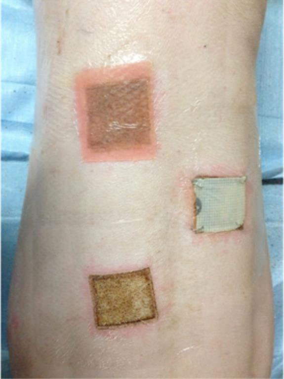 Figure 1: Burn wound with a hot plate on the specimen back.