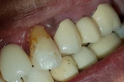Figure 10: Accurate margin fitting and with the same occlusal as before abutment fracture.