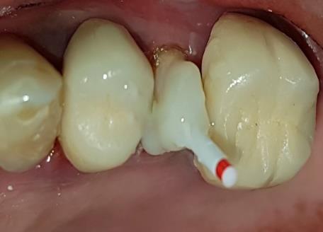 Figure 5: removing of fractured abutment from the intaglio surface of the crown.