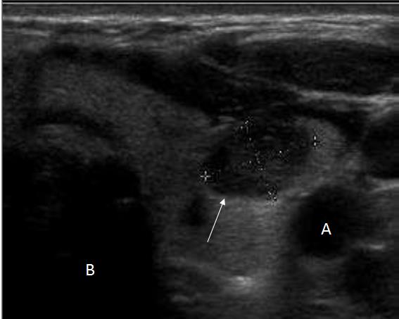 Figure 2: transverse section of the thyroid showing a solid hypoechogen nodule (arrow) with presence of course calcifications. A: Internal carotid; B: Windpipe (picture: ORL department university hospital of Cocody)