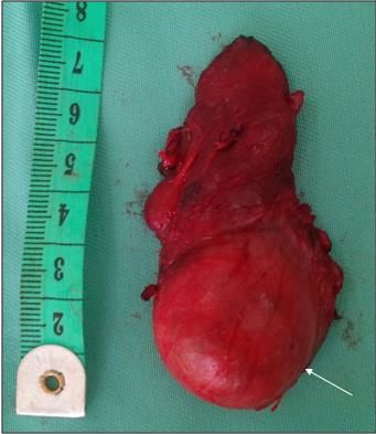 Figure 5: surgical specimen after right lobectomy demonstrating an inferior pole nodule of the right thyroid lobe (arrow). (Picture: ORL department of Cocody)