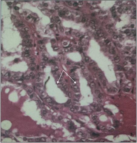 Figure 7: Cytological aspect of papillary carcinoma with the presence of a pale nucleus (arrows).