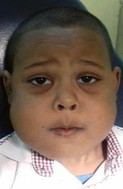 Figure 1: Facial view shows bilateral swelling of the mandible.