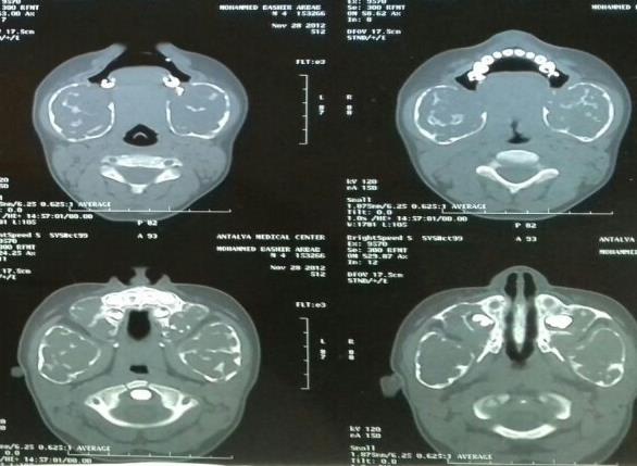 Figure 6: Intra operative view of the midline bucco-lingual lesion shows fibrotic fleshy tissues.