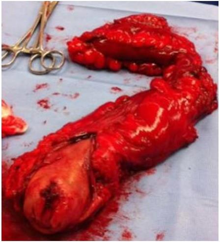 Figure 3: Low Rectal cancer Specimen after neoadjuvant chemo-radiation done by laparoscopic surgery In Al-Zahra Cancer center, Dubai January 2018, Al Zahra Cancer Center, Dubai UAE.
