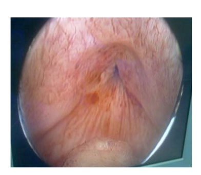 Figure 3: Bladder neck sclerosis.