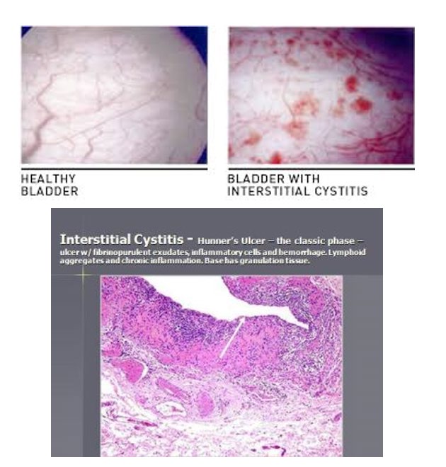 Figure 4: Show healthy bladder and bladder with cystitis.