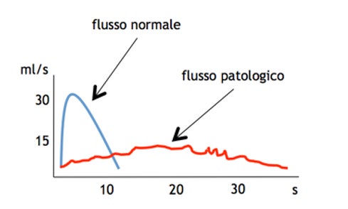 Figure 6: BPH show the benign prostatic hyperplasia.