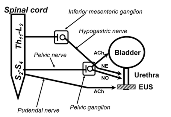 Figure 9: Flow pattern in uretral stricture bladder sinteric-bladder neck dis-sinergy: absence of relax bladder neck during detrusor contraction.