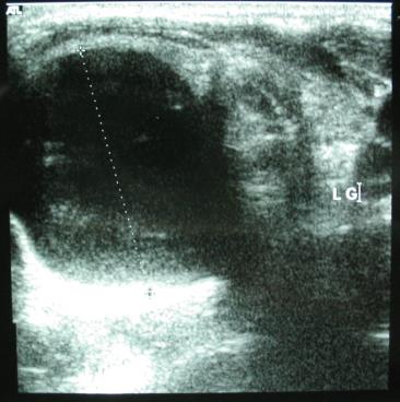 Figure 1: Cervical ultrasound: Uni-vesicular and anechoic mass of 25 mm in diameter at the expense of the right thyroid lobe.