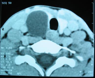 Figure 2: Cervical CT in axial section without (a) and with (b) injection of contrast: well limited, and non-enhanced cystic mass at the expense of the right lobe of the thyroid.